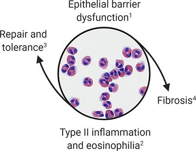 Eosinophils in Eosinophilic Esophagitis: The Road to <mark class="highlighted">Fibrostenosis</mark> is Paved With Good Intentions